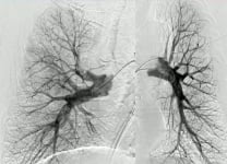 Pulmonary embolism: breaking the clot barrier