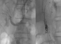 Management of a type II endoleak  after thoraco-abdominal aneurysm endovascular exclusion