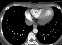 when drug are not the solution: resistant hypertension calls for more