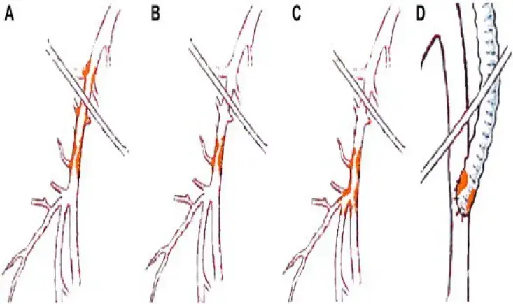 How to manage CFA lesions with an endovascular approach 