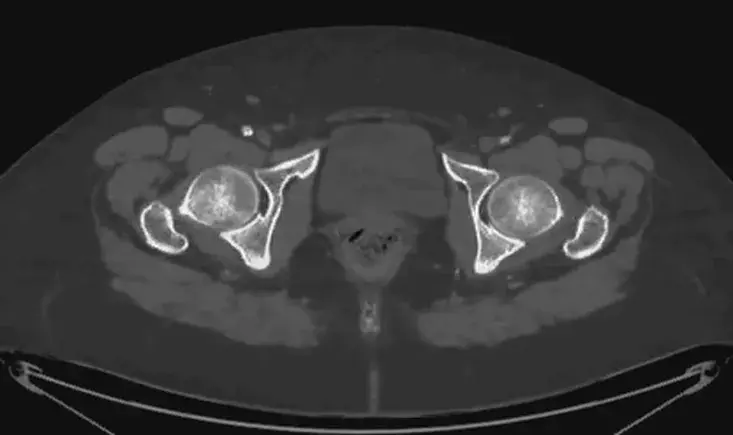 Acute limb ischemia and aortic thrombosis 