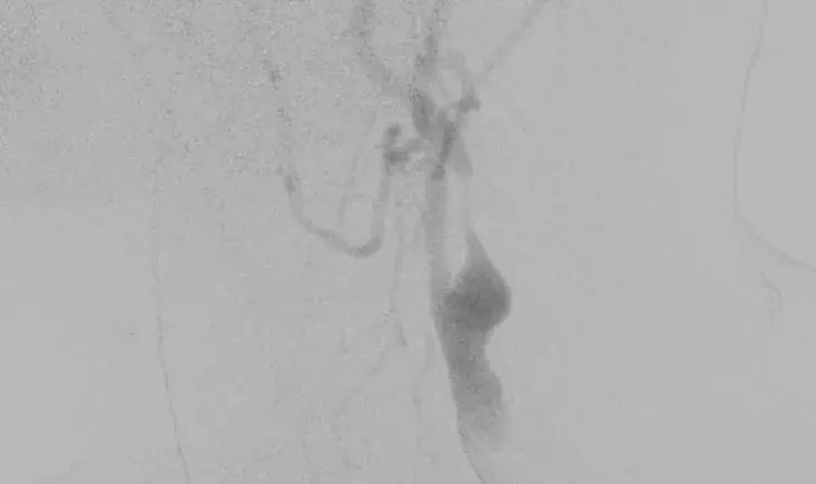 Carotid artery stenting for post radiation stenosis