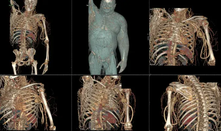 Superior Vena Cava Syndrome in patient with ESRD