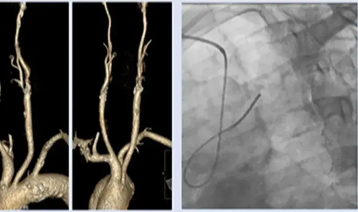 EuroPCR @ PVI: update on carotid angioplasty and stenting