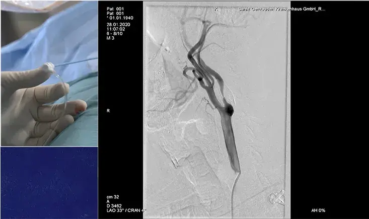 Live in the box - Carotid