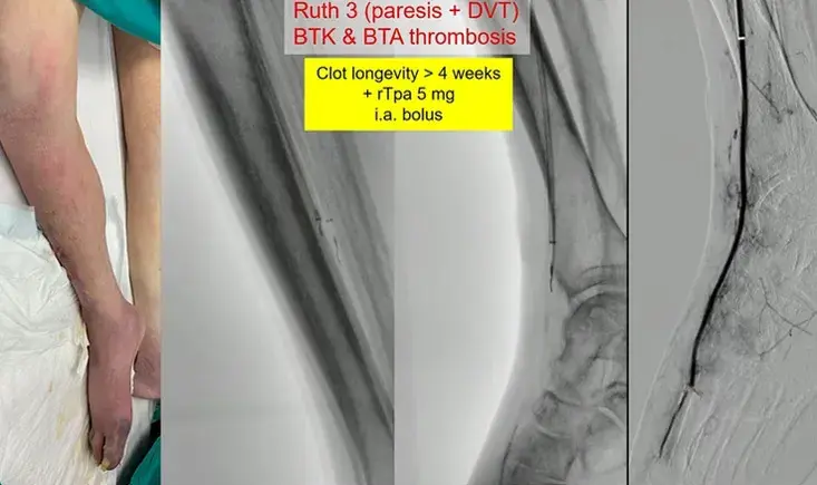 Acute limb ischemia: new perspectives