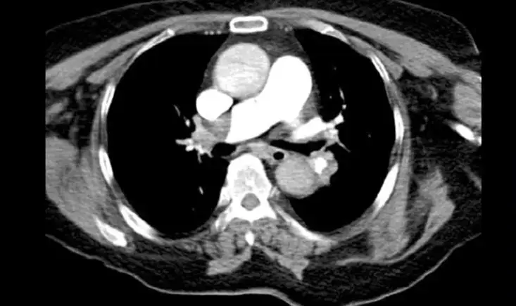 Contemporary management of pulmonary embolism