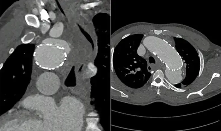 Descending thoracic aorta and dissections