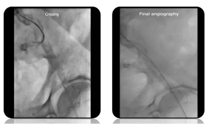 Vascupedia @ PVI: Open surgery for peripheral occlusive disease. How to do it