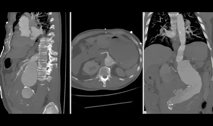 Let's talk aorta!