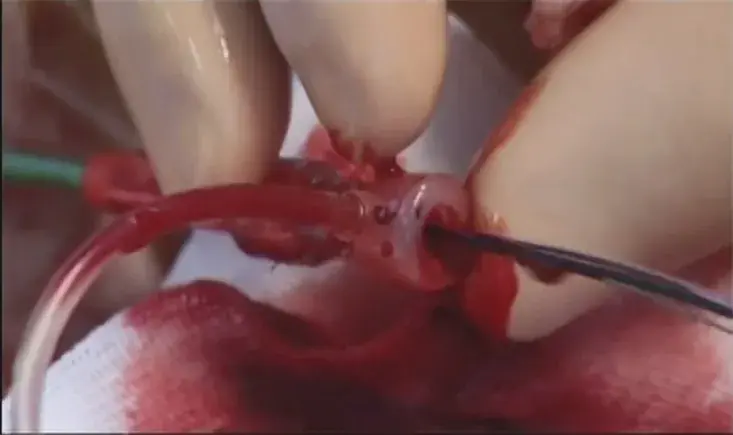 The common femoral artery: from open to endo