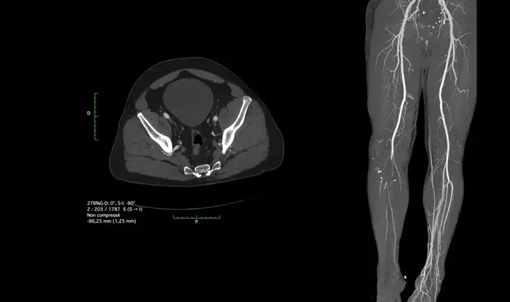 Right tibial fracture & vascular lesion 