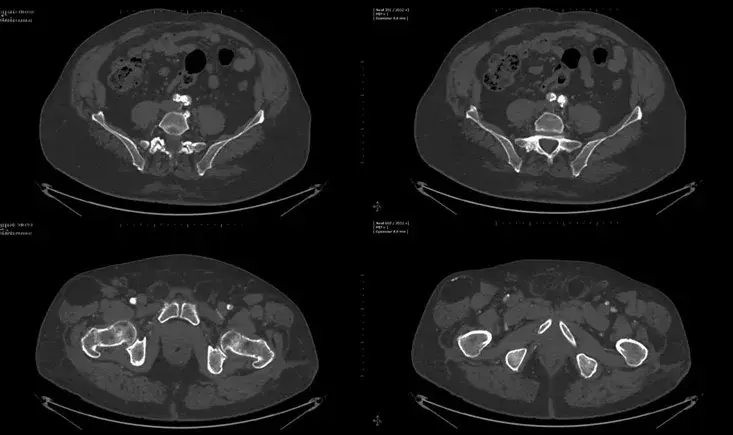 Approach: puncture of stented femoral artery