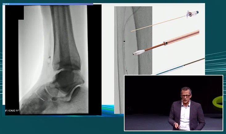 Simplifying complex BTK interventions with Oscar