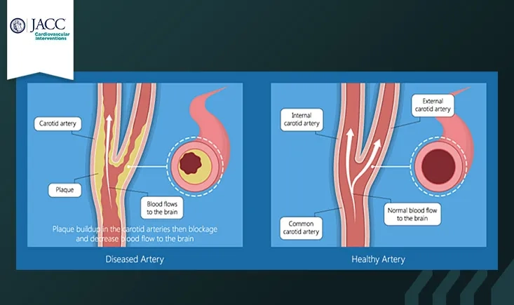The PERFORMANCE II Trial: a prospective multicenter investigation of a novel carotid stent system