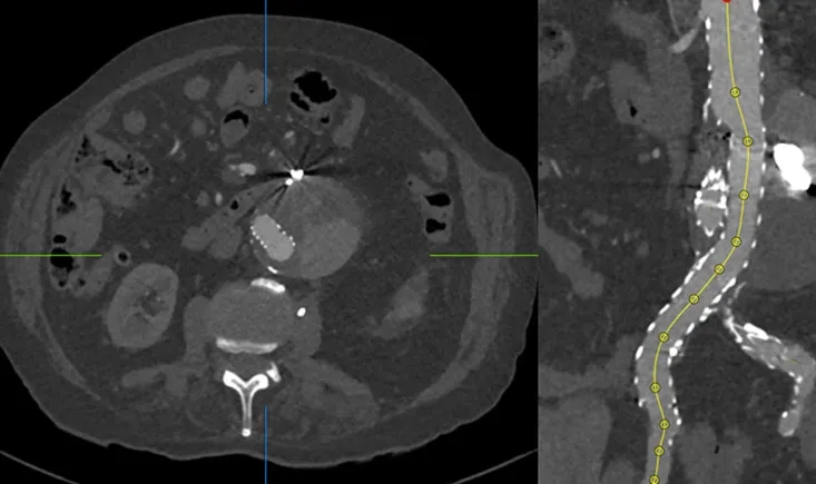 Re-do endovascular endoleak embolisation by transprosthetic puncture after endovascular aneurysm repair