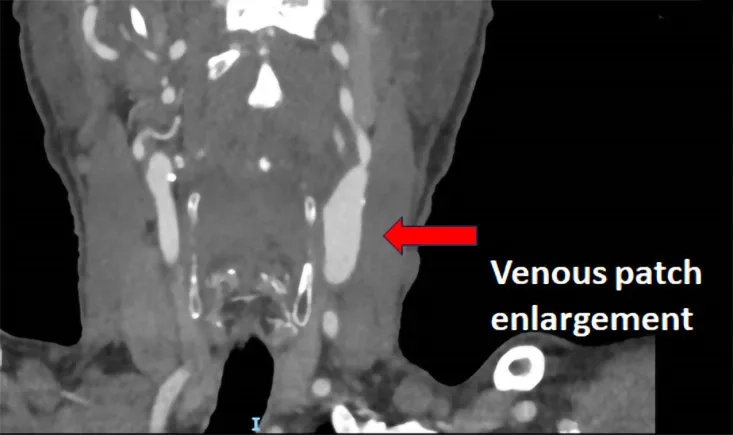 Unusual carotid enlargement after CEA