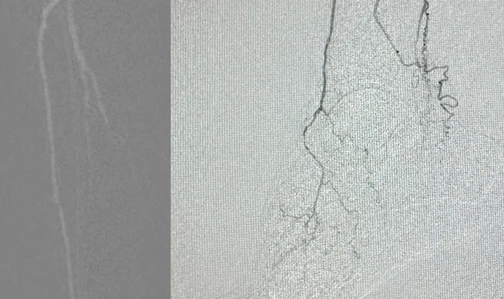 Treatment for no-option CLTI patient
