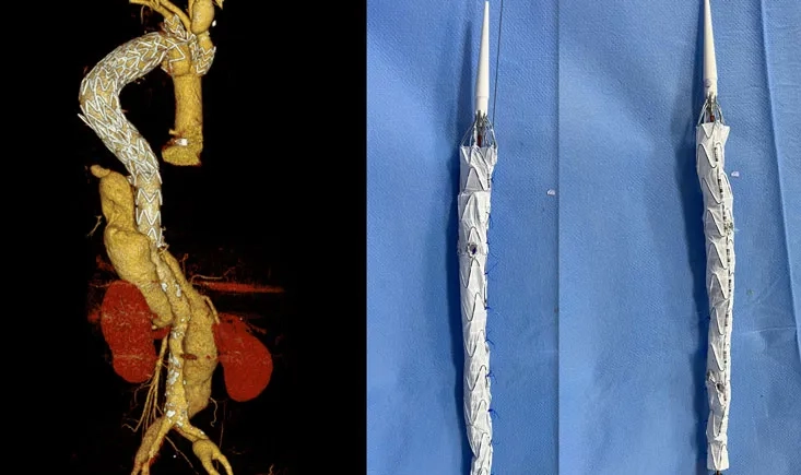 Total endo‑aortic repair for a triple‑lumen post‑dissection TAAA