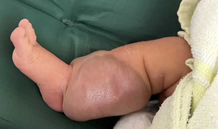 7-days old baby with AV Malformation