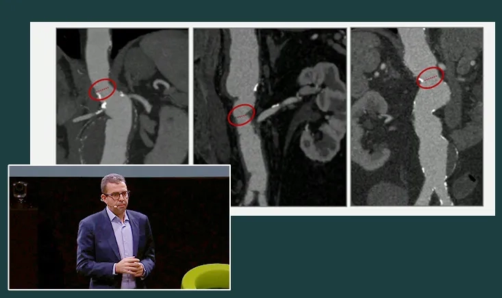Complex aneurysms are not complex anymore