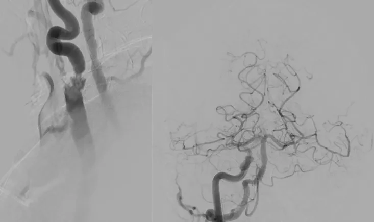 Severe carotid artery stenosis associated with contralateral carotid occlusion