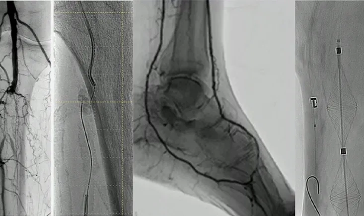 Newest tools and technologies on the PAD-treatment horizon