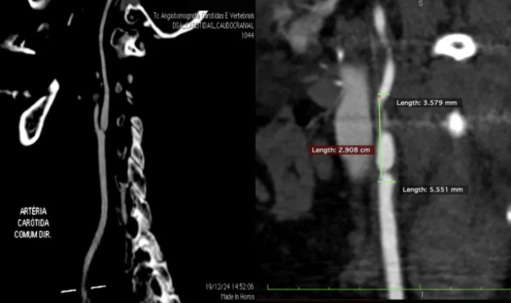 Carotid stenosis: the athero-mystery