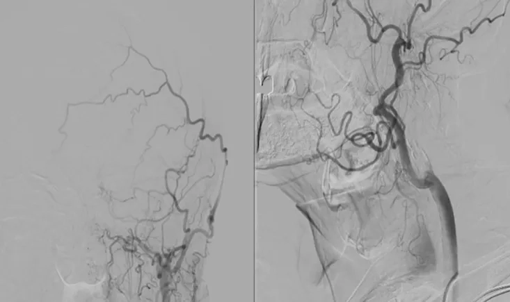 TIA in bilateral severe carotid disease