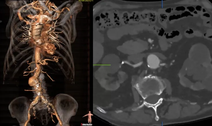 Treatment of recurrent endoleak type II
