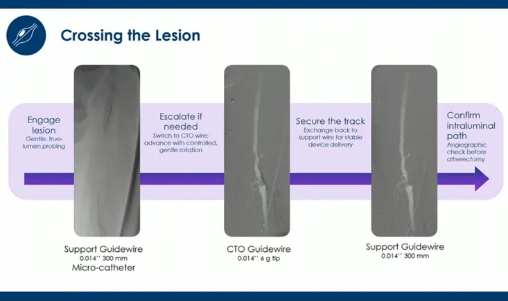 Modern endovascular decisions for SFA intervention 