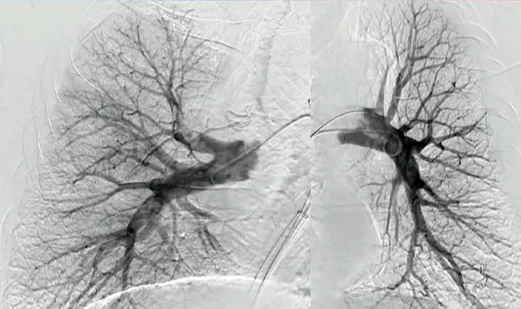 Pulmonary embolism: breaking the clot barrier