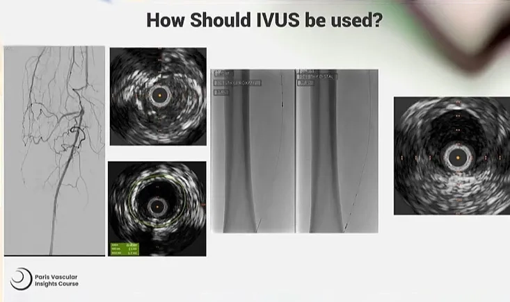 The value of IVUS in PAD procedures: a game changer