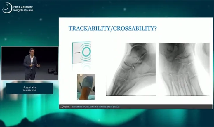Shockwave IVL: cracking the barriers of below-the-knee disease