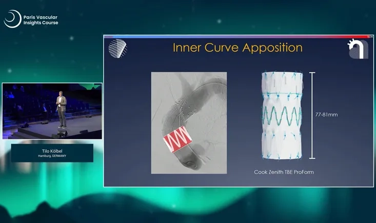 Latest developments in the Ascending Aorta and Arch