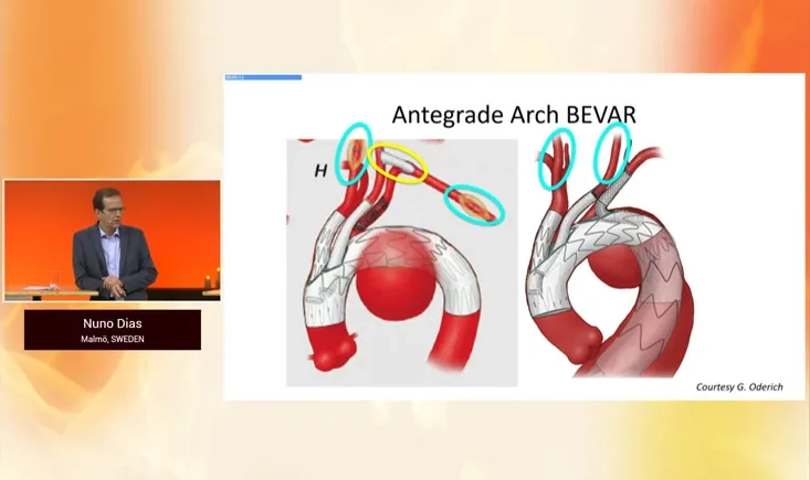 Navigating the complexities of aortic repair
