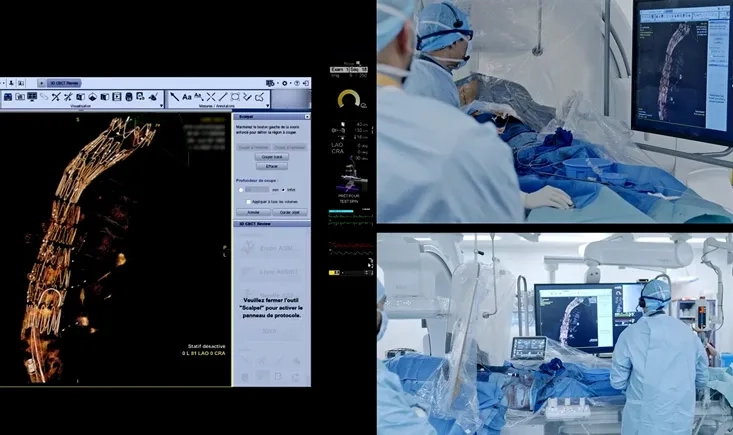 Recorded step-by-step EVAR: How does NextGen HOR improve my daily practice