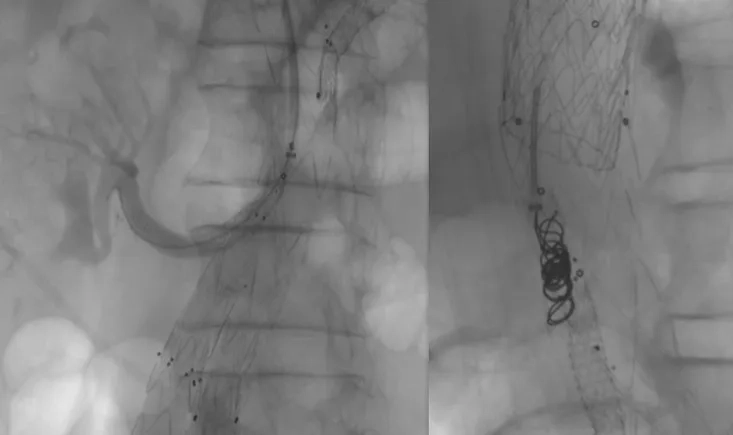 Management of a type II endoleak  after thoraco-abdominal aneurysm endovascular exclusion
