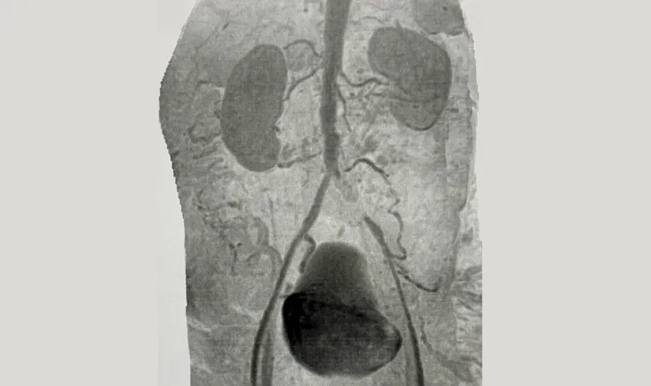 Unilateral iliac artery  total occlusion