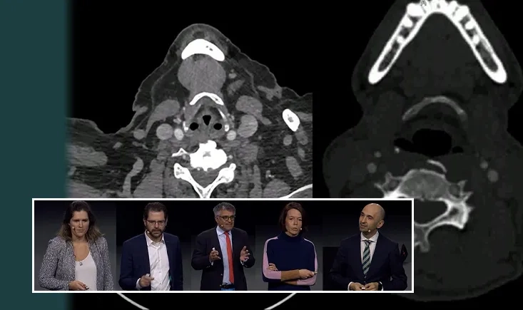 Carotid stenting: devices, neuroprotection and strategy