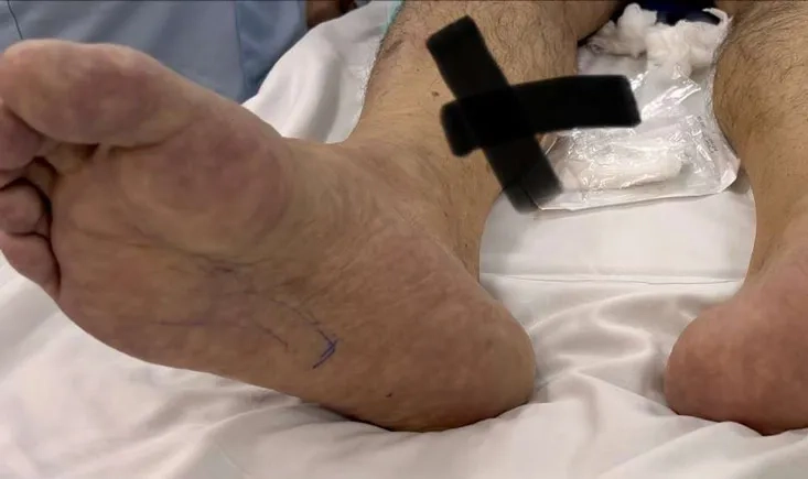Acute limb ischemia: common femoral artery occlusion