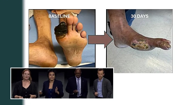 DCBs, CLTI & complex aorta: new trial data