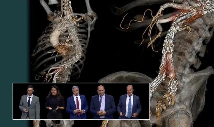 From acute to chronic aortic dissection