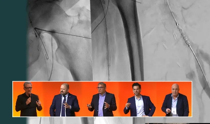 Peripheral ISR: DCB, IVL and debulking strategies – The cardiologist's point of view