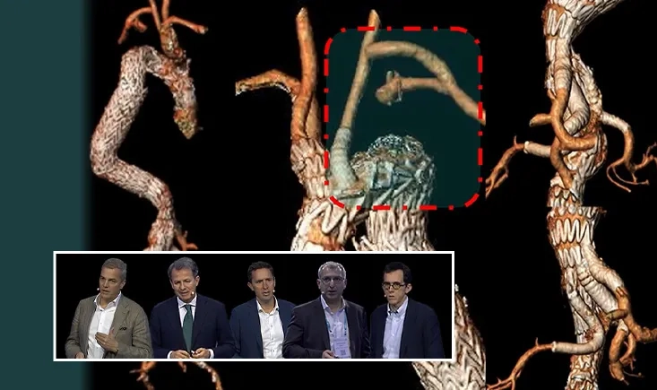 Latest developments in the Ascending Aorta and Arch