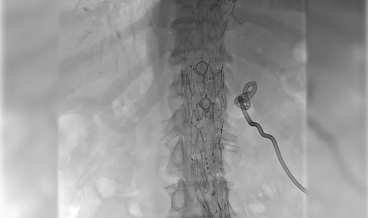 Coeliac Pseudo aneurysm treatment in emergency