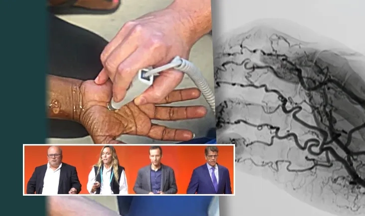 From nutcracker syndrome to complex aortic complications
