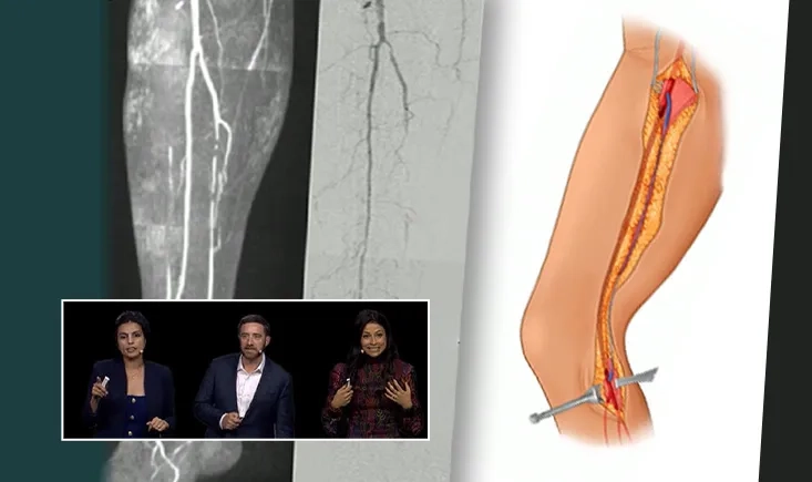Back to the future in lower limb PAD