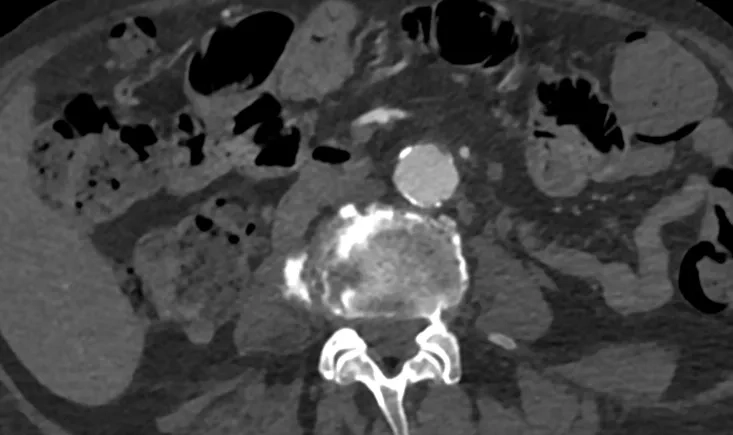 When a juxtarenal aneurysm raises an infectious concern