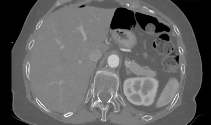 Aorto-iliac treatment